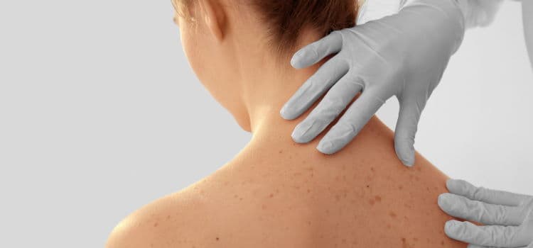 Skin Cancer Screening in Boca Raton